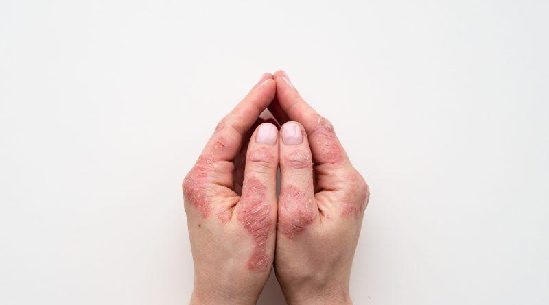 Artrite Psoriásica