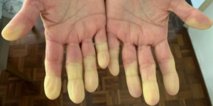 Mãos com dedos pálidos e amarelados, característicos do Fenômeno de Raynaud. Esta condição afeta a circulação sanguínea nas extremidades, causando mudanças de cor nos dedos, especialmente quando expostos ao frio ou estresse.